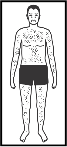 Skin rash-whole body